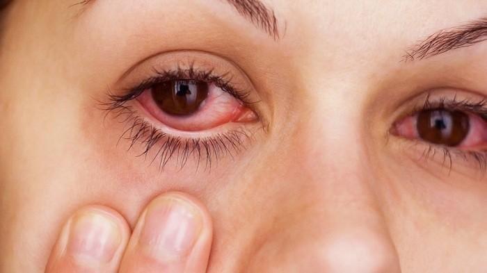 Beberapa cara alami untuk obati gejala iritasi pada mata