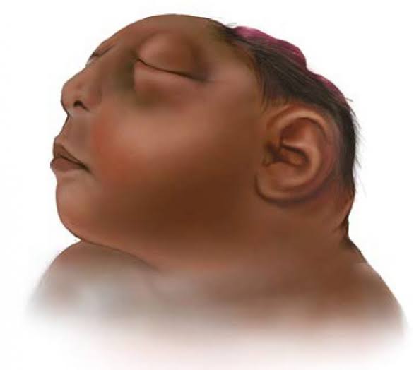 Mengenal Kondisi Anencephaly Beserta Penyebabnya – Factsonline.co